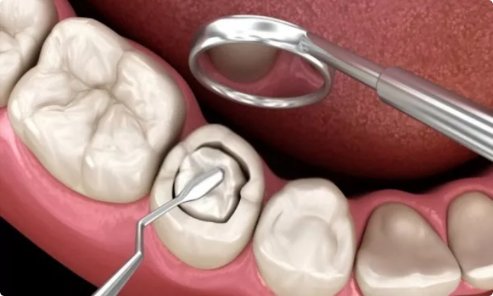 aesthetic-dentistry-composite-filling-1