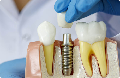 dental-implant-3
