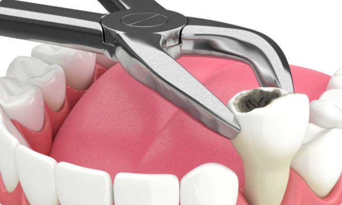 general-dental-treatment-extractions-2