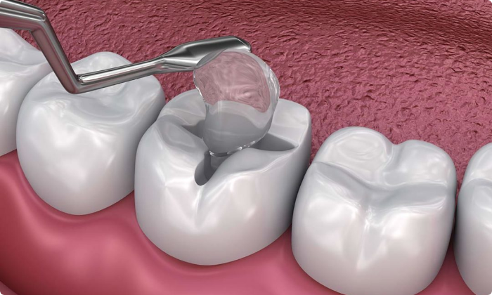 general-dental-treatment-fillings-1