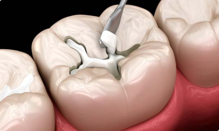 general-dental-treatment-fillings-2