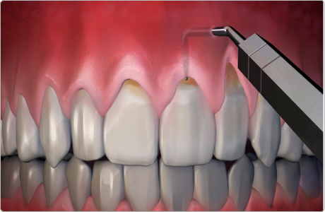 gum-treatment-and-surgery-4