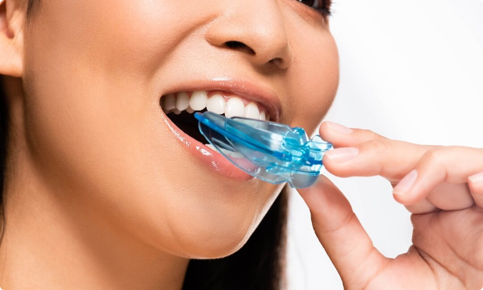 jaw-pain-and-bruxism-mouth-guards-2