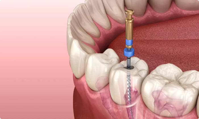root-canal-treatment-1