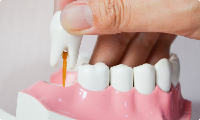 wisdom-tooth-removal-1